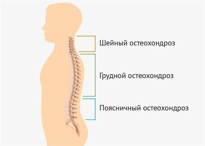 Стадии остеохондроза и их влияние на военную пригодность